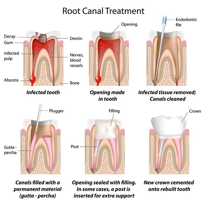 Root canal treatment. (Image: Shutterstock)