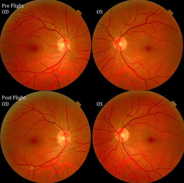 Fundus examination of first case of visual changes from long-duration spaceflight. Fundus examination revealed choroidal folds inferior to the optic disc and a single cotton-wool spot in the inferior arcade of the right eye (white arrows). (Photo: Wikimedia/NASA)