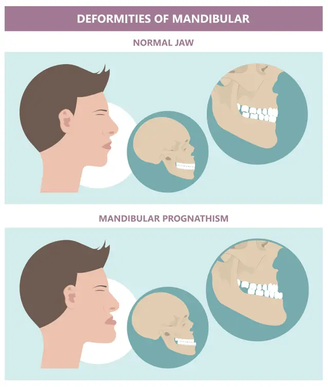 The Habsburg jaw featured a facial deformity typical of mandibular prognathism, otherwise known as MP, or protruding jaw, alongside maxillary deficiency, the upper jaw lacking development. (Image: Shutterstock)