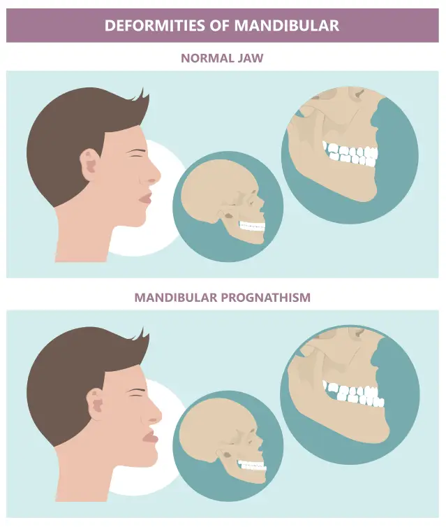 What caused the Habsburg royal family's jaw deformity? Blame